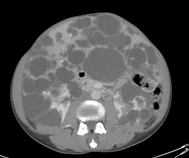 Doença renal policística e Transplante de Fígado: o nefrologista deve ficar atento a indicação