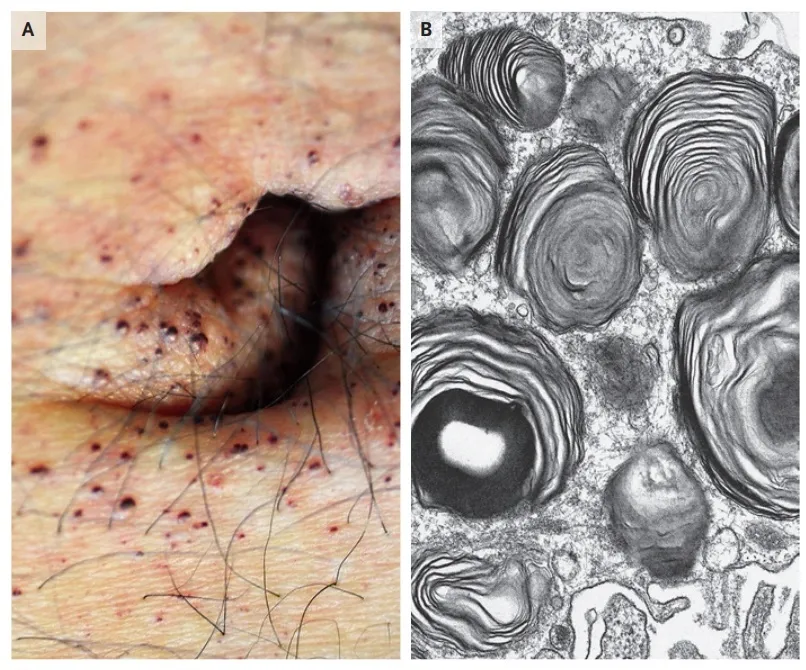 Fabry: pequenos sinais que levam ao diagnóstico!