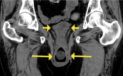 Prolapso uterino causando IRA pós renal