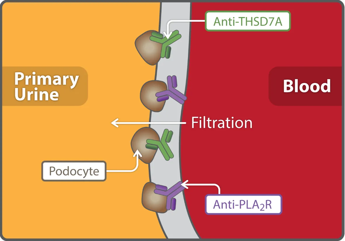 Nova classificação da Nefropatia Membranosa