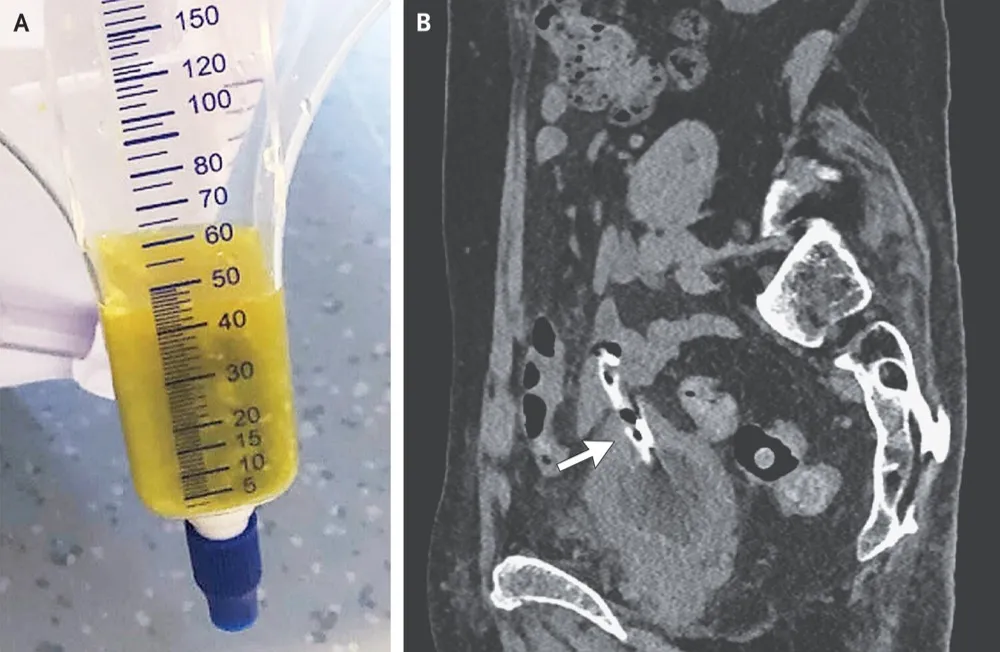 Complicação grave secundária a cateter uretral