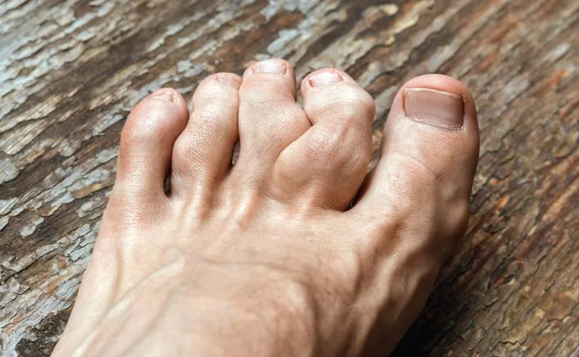 Tratamento da Gota aguda e crônica no paciente com DRC: como fazer?