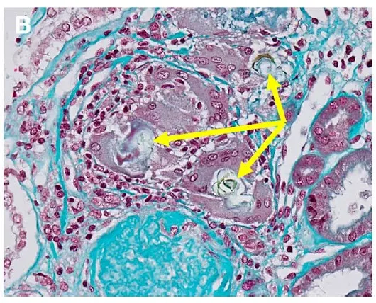 Hipercalcemia e linfadenopatia