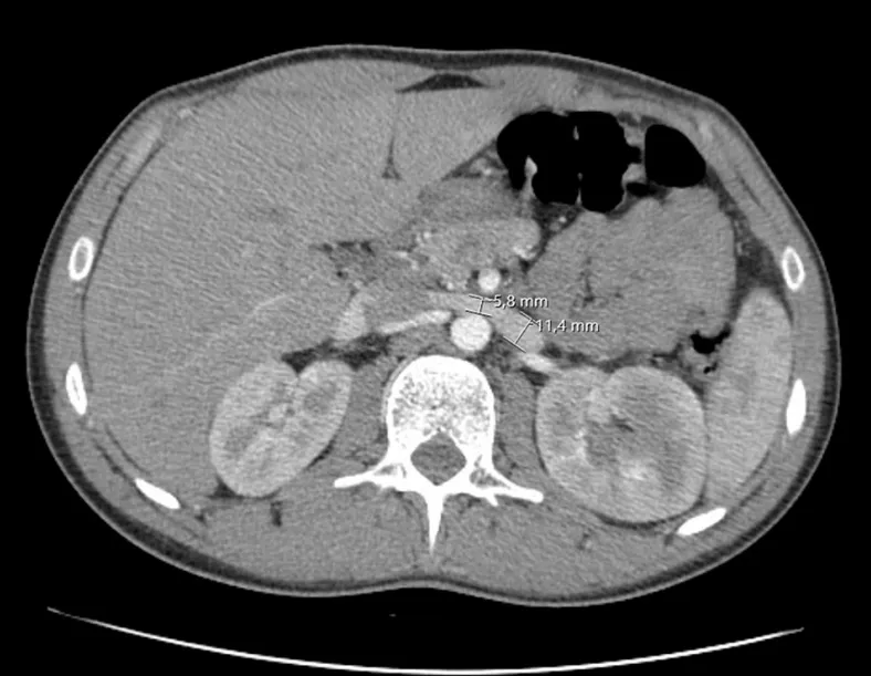 Lombalgia e hematúria, uma causa incomum