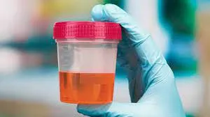 Hematuria na Nefropatia por IgA Por que o Nefrologista precisa se preocupar?