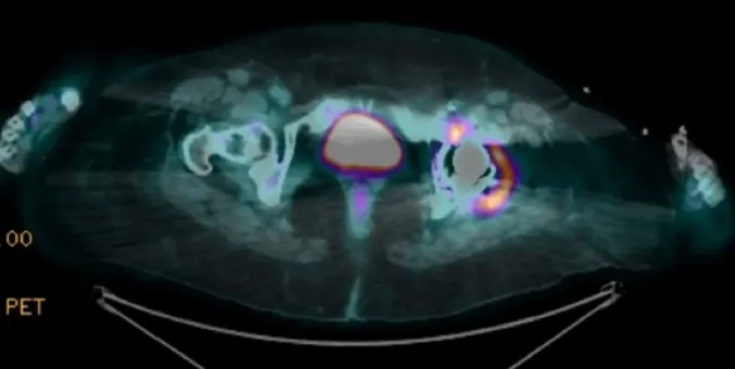 Hipercalcemia na era moderna: expandindo os diagnósticos diferenciais