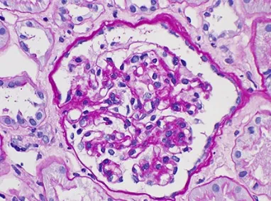 Budesonide na Nefropatia por IgA, o que sabemos até o momento?