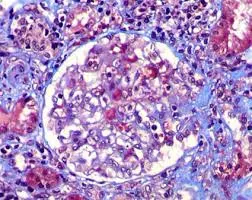 Atualizações KDIGO 2024 Nefropatia da IgA (parte 3): o que vem de novoem um futuro próximo no tratamento