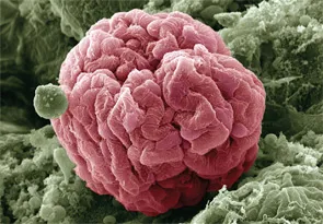 Atualizações KDIGO 2024: Nefropatia da IgA (parte 1)