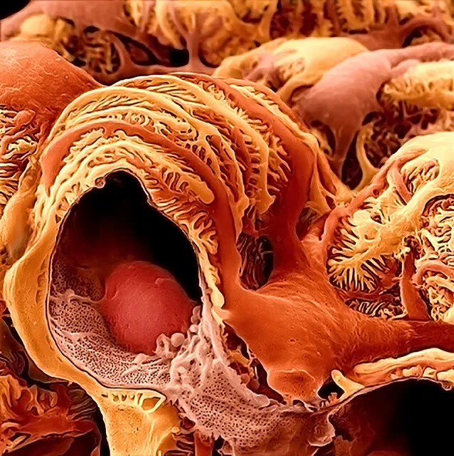 Atualizações KDIGO 2024: Nefropatia da IgA (parte 2)