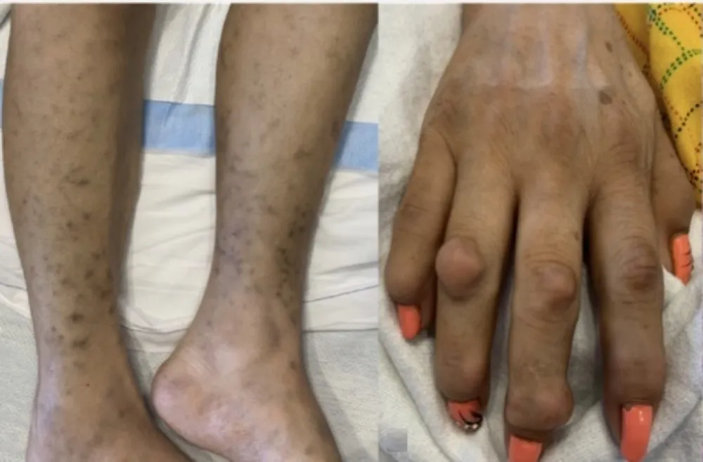 Nódulos cutâneos e DRC