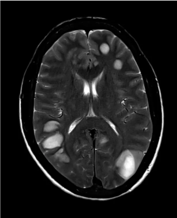 Rebaixamento de consciência em um transplantado renal
