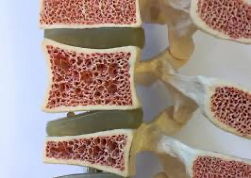 Reposição de bicarbonato de sódio e o turnover ósseo na DRC