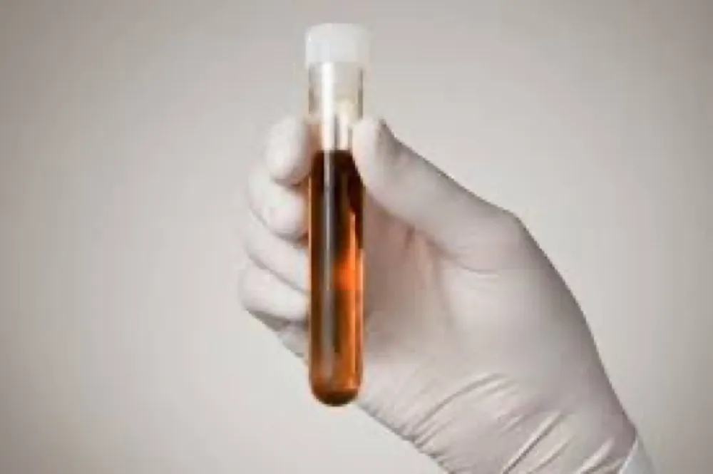 Como tratar IRA por Rabdomiólise?