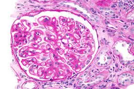 Tratamento da nefropatia membranosa em foco: Ponticelli “dose reduzida” vs padrão