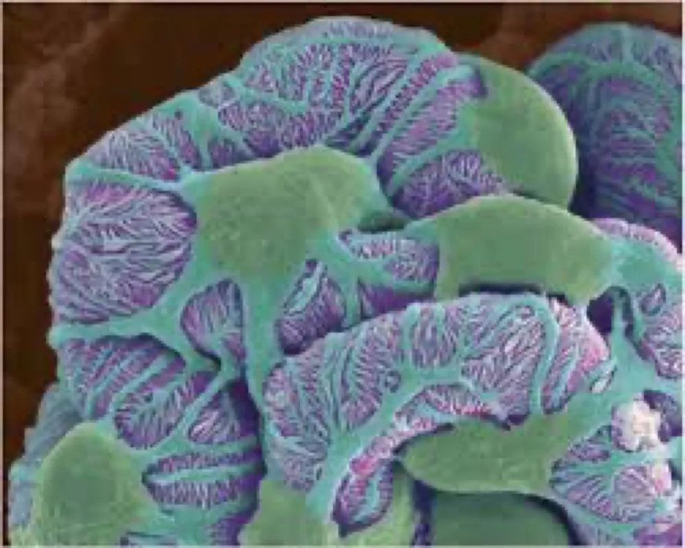 Doença por lesões mínimas recorrente no adulto, quais são as opções?