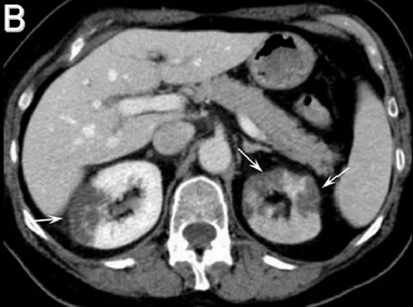Febre e dor no flanco: pielonefrite ou infarto renal?