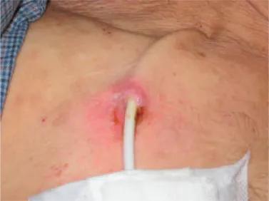 Sexta, 15h. O cateter infecta, a gestante incha e tem um caso de IRA com plaquetopenia – e agora?