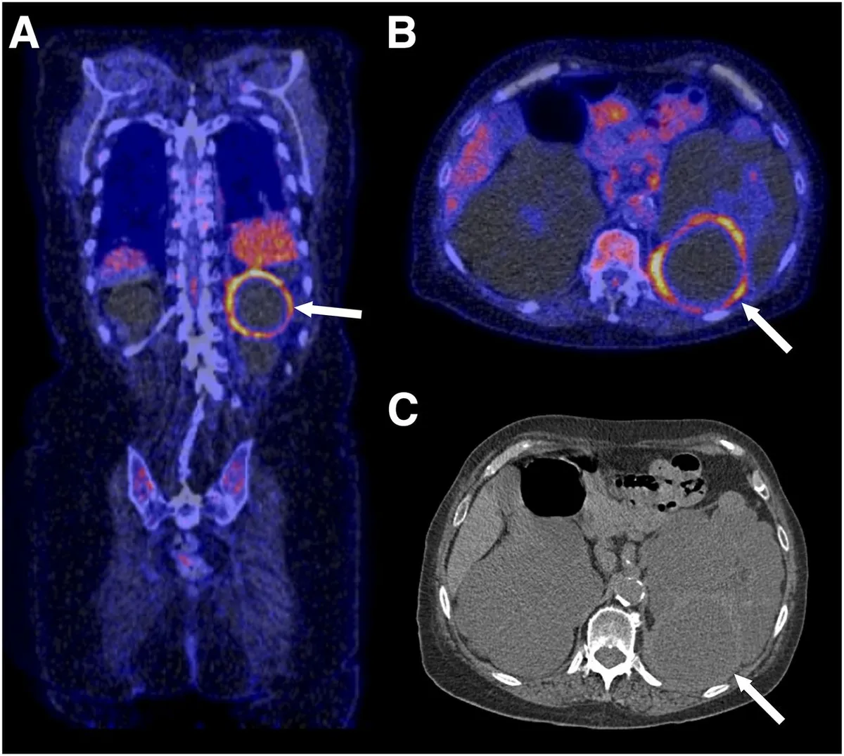 Infecção do trato urinário na DRPAD: detalhes que fazem diferença!