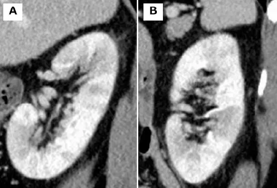 Paciente com IRA associada a Inibidores de Checkpoint