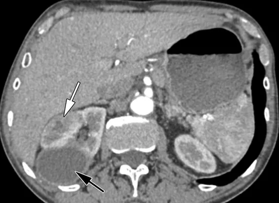 Abscessos Renais: como tratar e quando indicar drenagem
