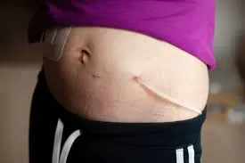 Kt/V peritoneal na prática: como calcular e como interpretar