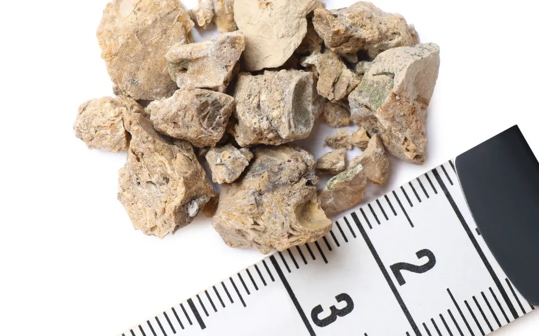 As 6 Recomendações Nível A da nova Diretriz Brasileira de Nefrolitíase que você não pode deixar de saber!