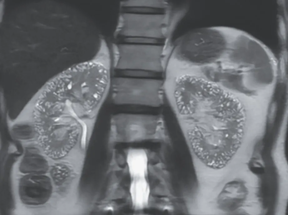 Microcistos renais e lítio: existe relação?