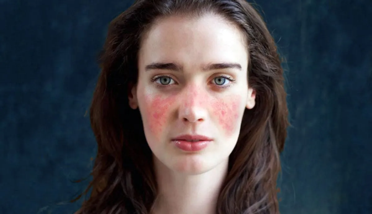 Glucocorticoides isolados na nefropatia lúpica classe I/II: proteção ou risco a longo prazo?