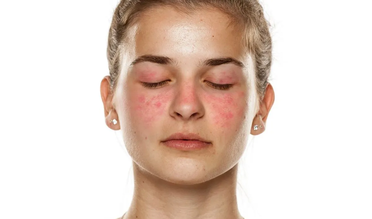 Nefrite Lúpica-redefinindo os objetivos do tratamento