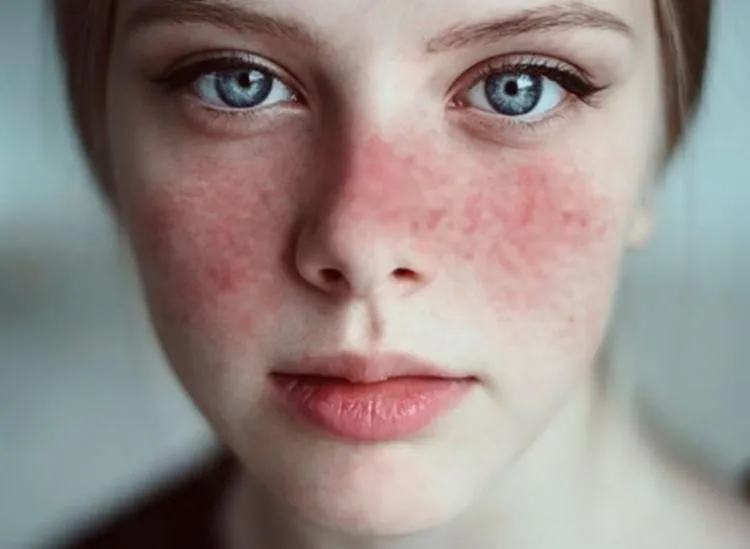 Transplante na Nefrite lúpica, o que esperar?