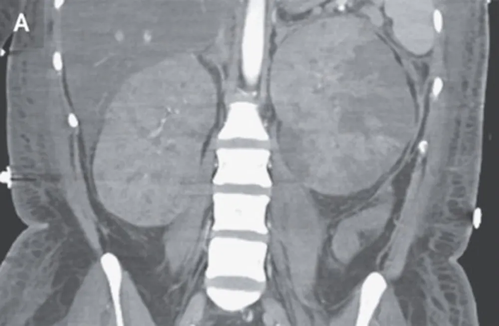 Malacoplaquia renal, você sabe o que é?