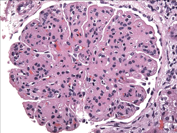 Como investigar a Membrano proliferativa de forma prática?