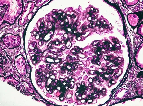 Esquema Multitarget para Nefropatia Membranosa, vale a pena?