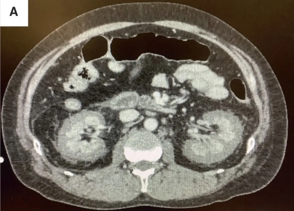 Necrose cortical renal, uma causa subdiagnosticada de IRA