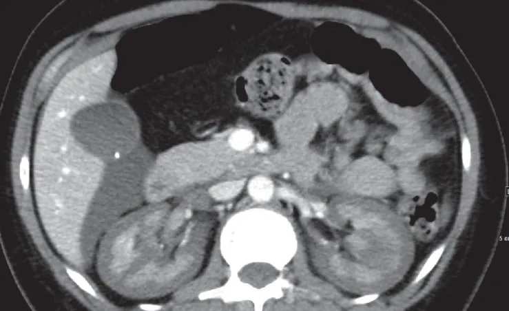 IRA em Mulher Jovem Após Curetagem
