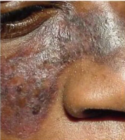 Nefrite Lúpica refratária