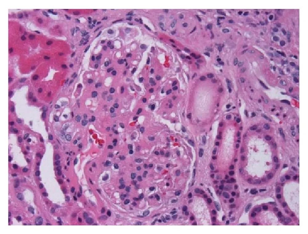 Corticosteroides em Pacientes com Nefropatia por IgA: será que "menos é mais"?