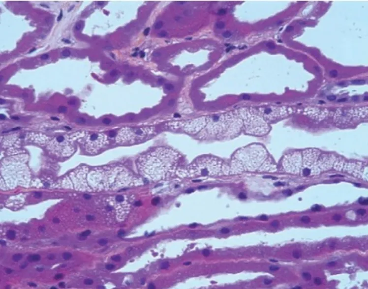 Nefropatia Osmótica induzida por iSGLT2