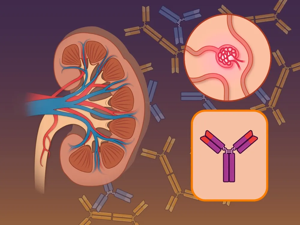 Sibeprenlimabe: mais uma novidade no tratamento da Nefropatia por IgA