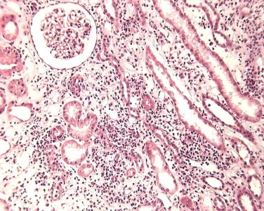 NIA Refratária a Corticoide: E Agora, o Que Fazer?