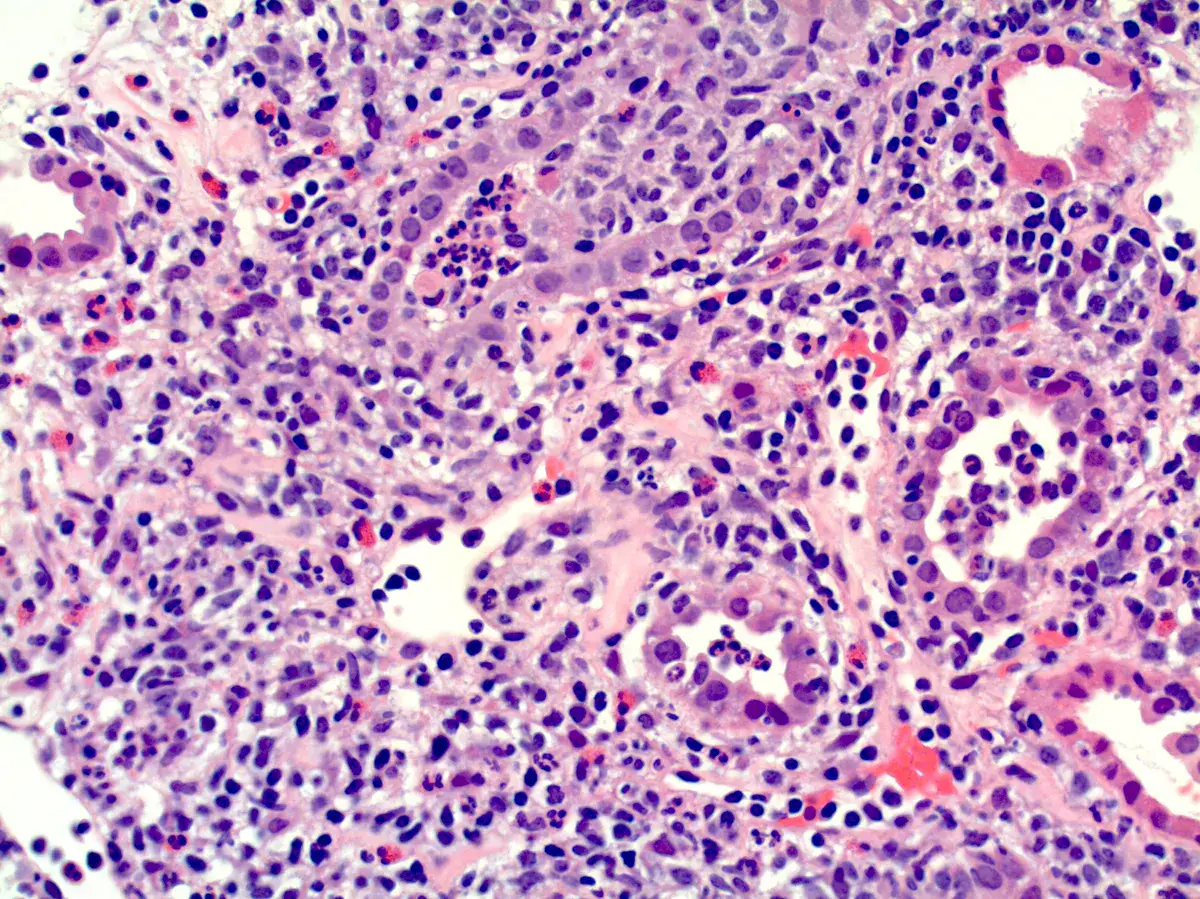 Quando e como prescrever corticoide na NIA?