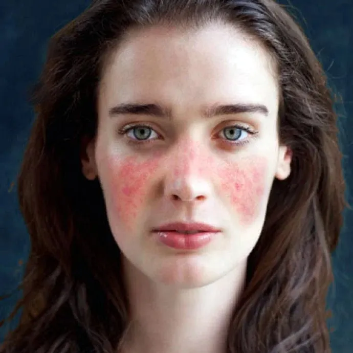 Vale mesmo a pena utilizar iSGLT2 na nefrite lúpica - o que dizem os guidelines?