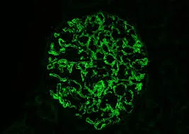 10 dicas sobre imunossupressão na Nefropatia Membranosa (parte 2)