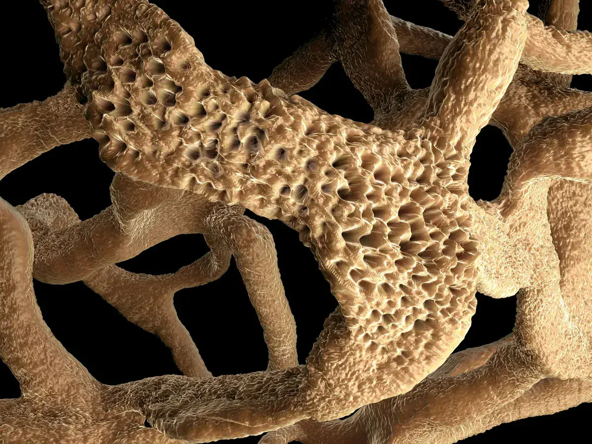 Manejo da Osteoporose no paciente dialítico