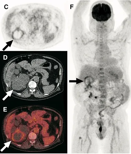 Infecção de Cistos na DRPAD — abordagem prática para diagnóstico