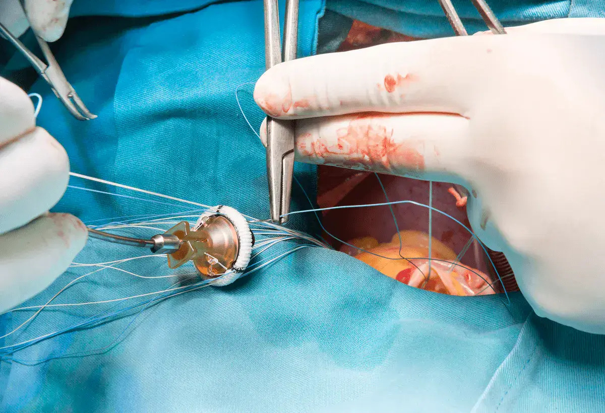 Progressão da estenose aórtica e DRC