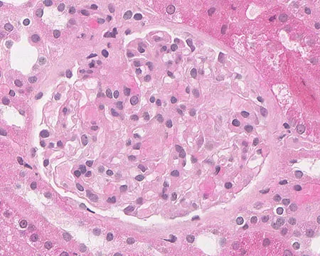 Amiloidose renal: aspectos sobre patogenia, diagnóstico e proteomica 