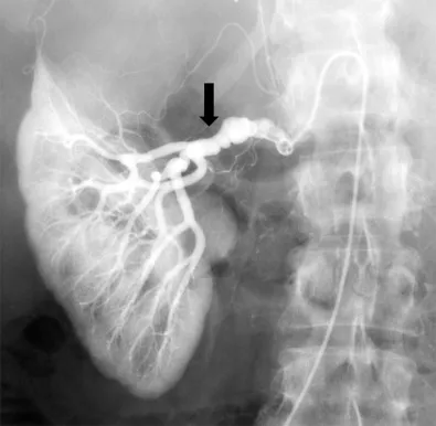 Investigação e diagnóstico da hipertensão renovascular