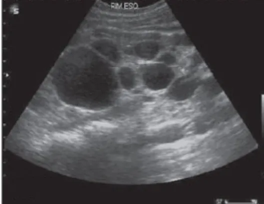 Cetogênese, uma estratégia de tratamento na DRPAD?